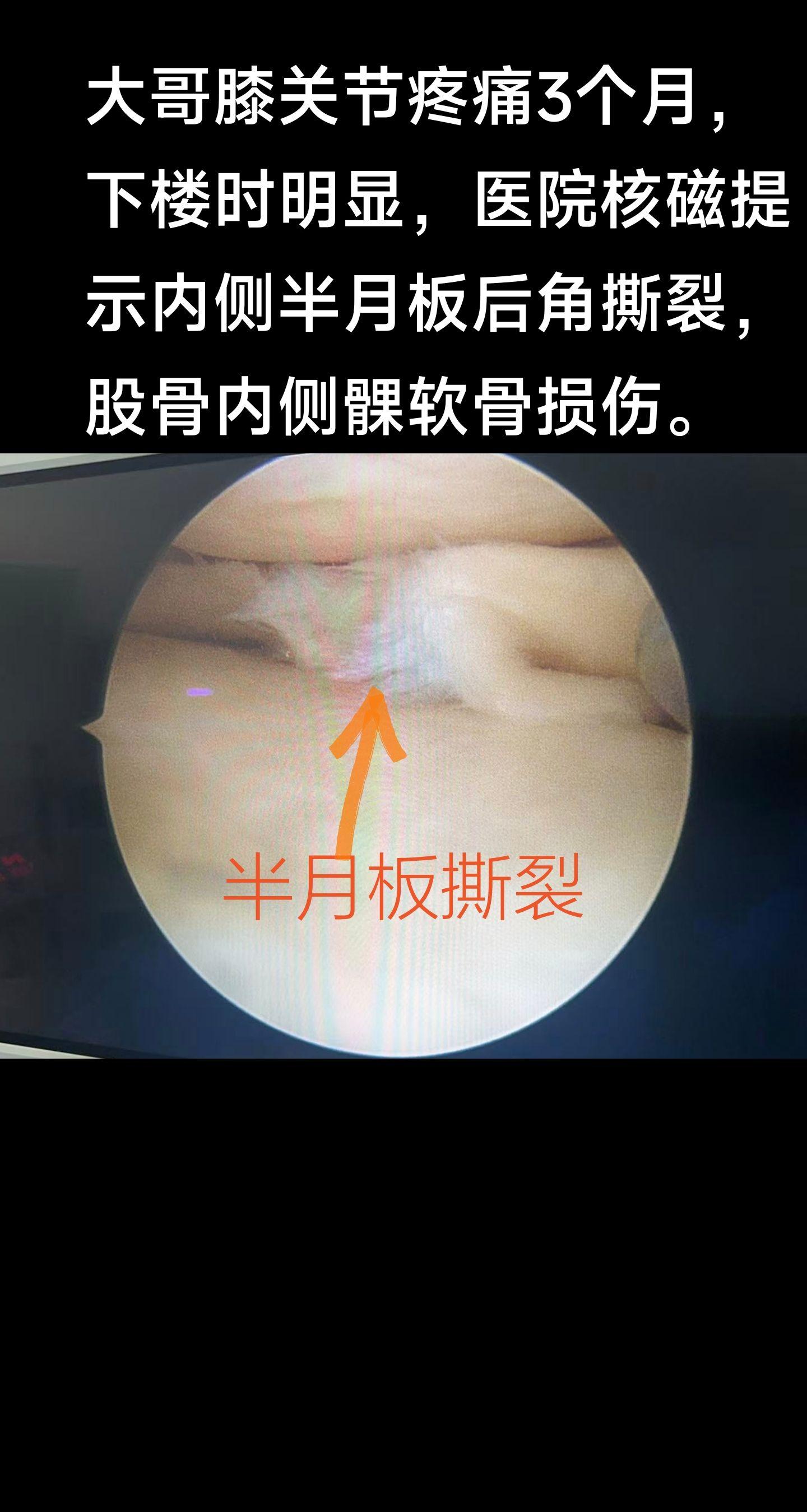半月板撕裂。