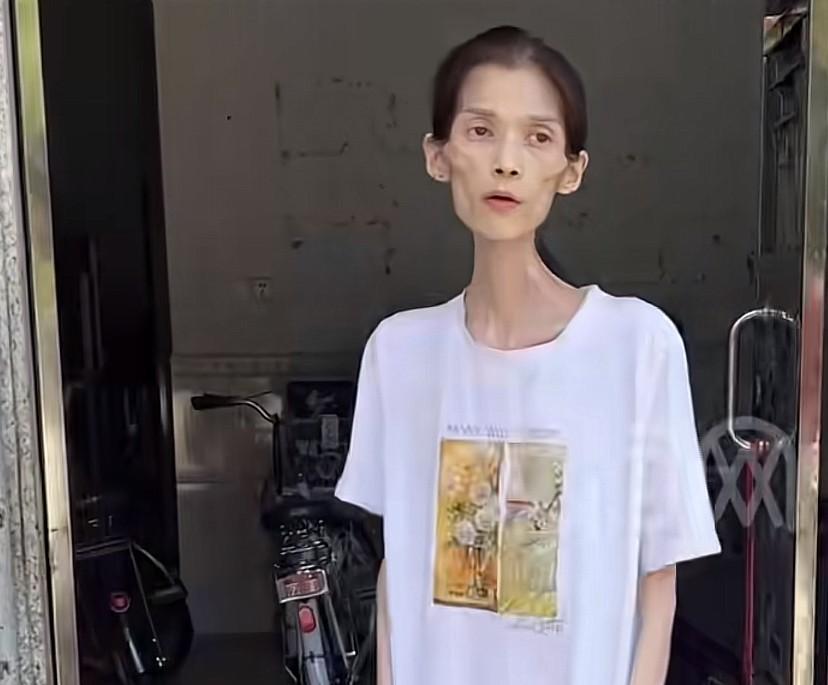 真的不敢想象！这么漂亮的一个女孩，会被疾病折磨成这样。胃萎缩导致女孩无法进食，只