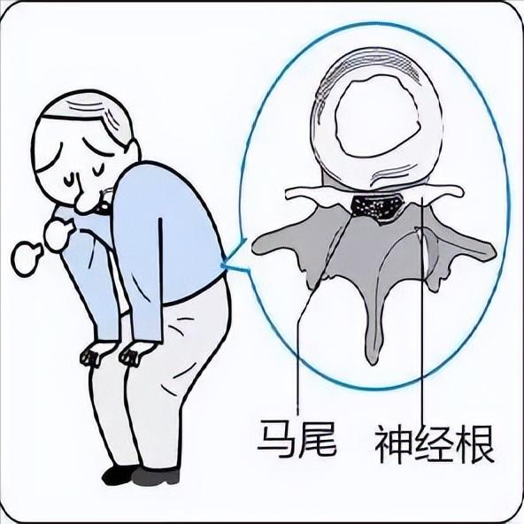 马尾损伤：不是瘫痪，却是比瘫痪更残忍的折磨！ 当我们谈论脊髓损伤时，大多数人