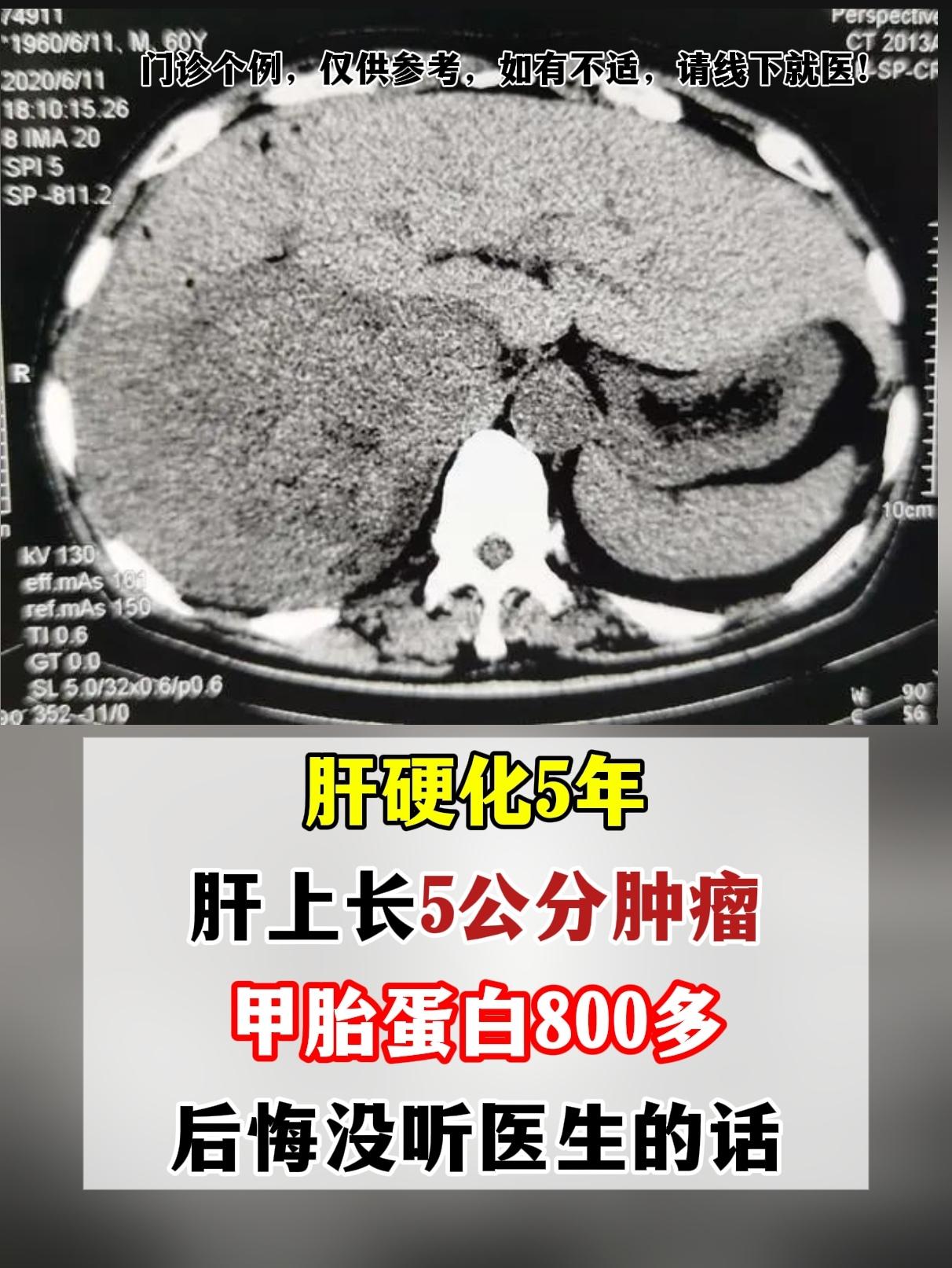 “教授，我真该听你的话，认真治疗啊！”。52 岁的李先生拿着检查报告给...