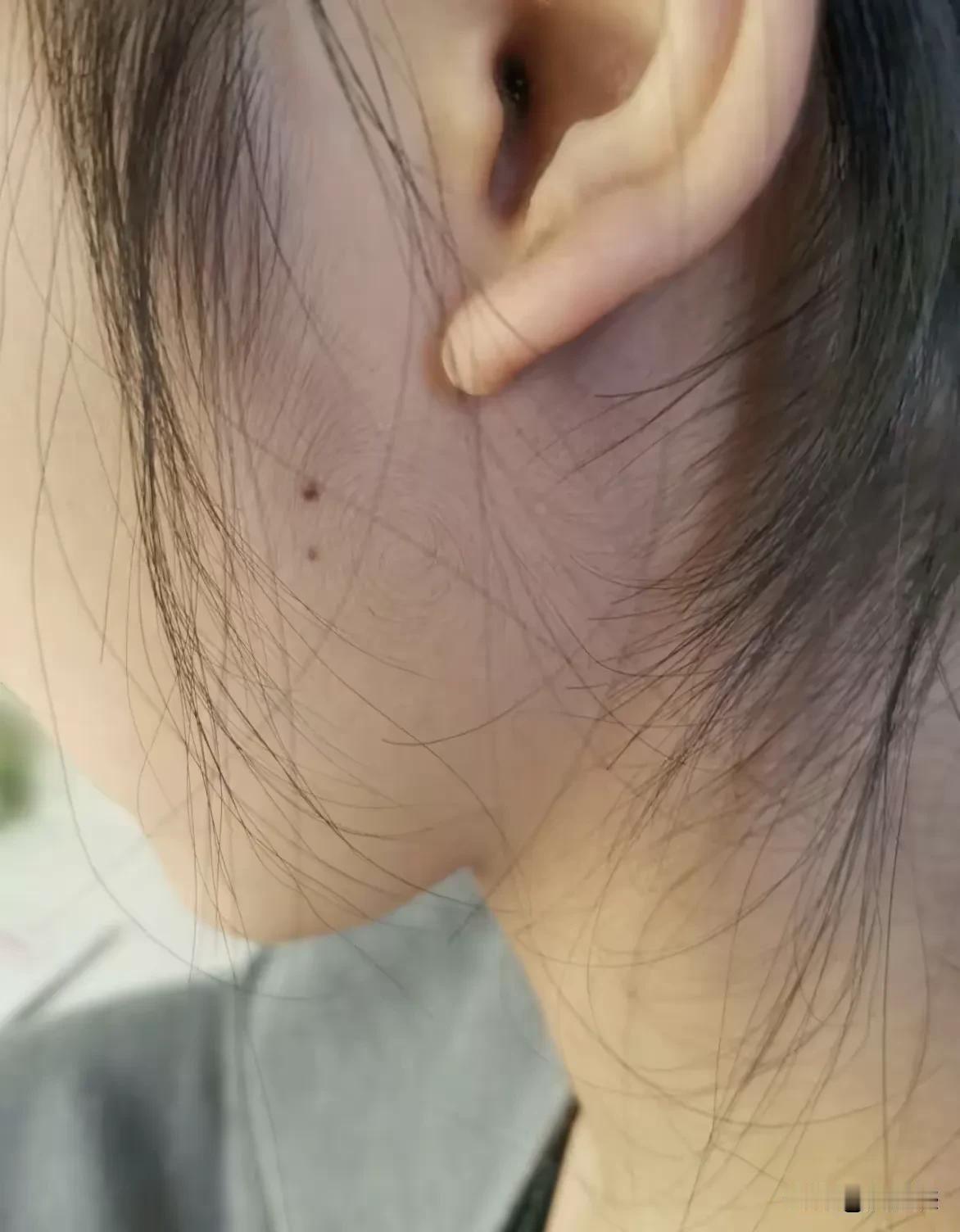 脸上也能长出漩儿来么，我是第一次见到