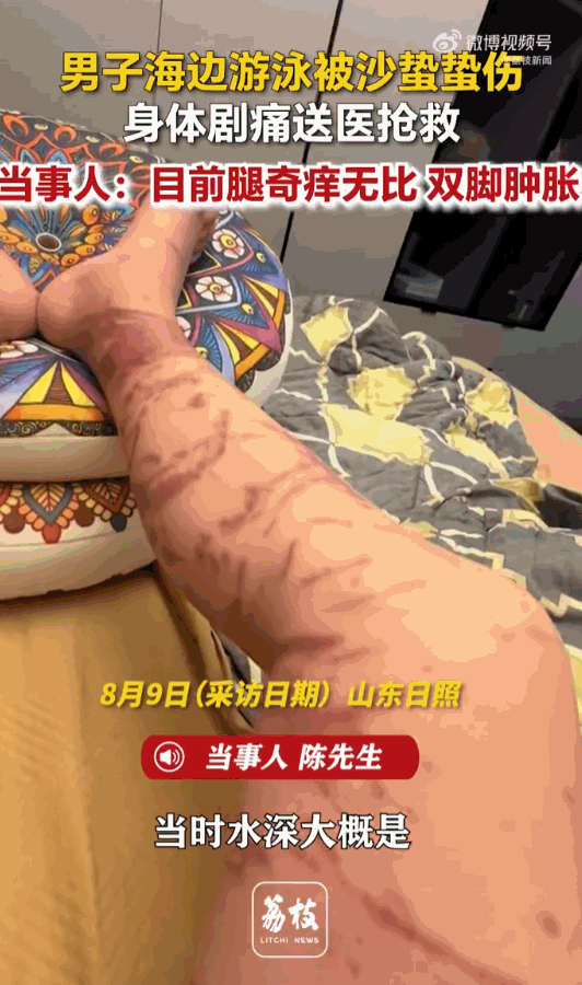 万万没想到！山东日照，男子下海游泳，谁能想到在浅水区突然遭遇了水下“隐形杀手”，