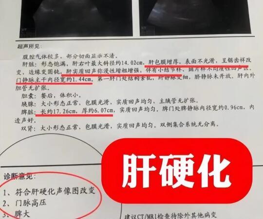 彩超的这几项描述要当心，小心是肝硬化的表现，这些异常提示都是肝损伤，具...