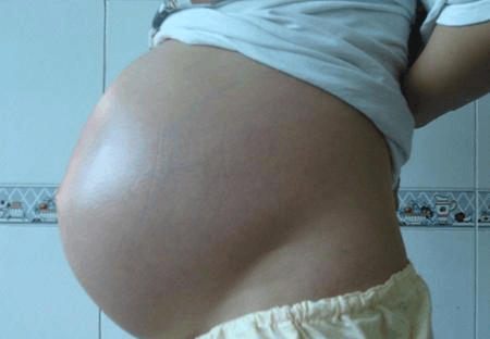 怀胎4月, 产妇肚子跟8个月的一样大, 经医生检查