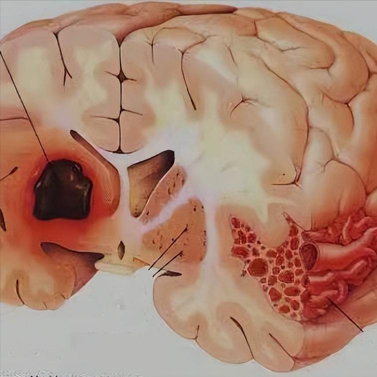 脑出血不是意外，是长期忽视的结果许多人误以为脑出血是突如其来的意外，但真相往往