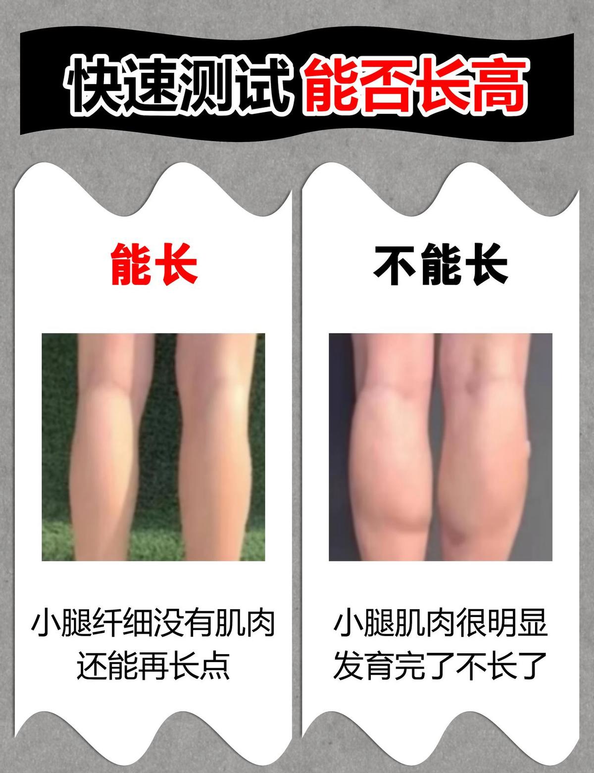 二十多岁掉发,别等秃了才慌。脂溢性脱发,早治早回头。米诺地尔+酮康唑洗头,不