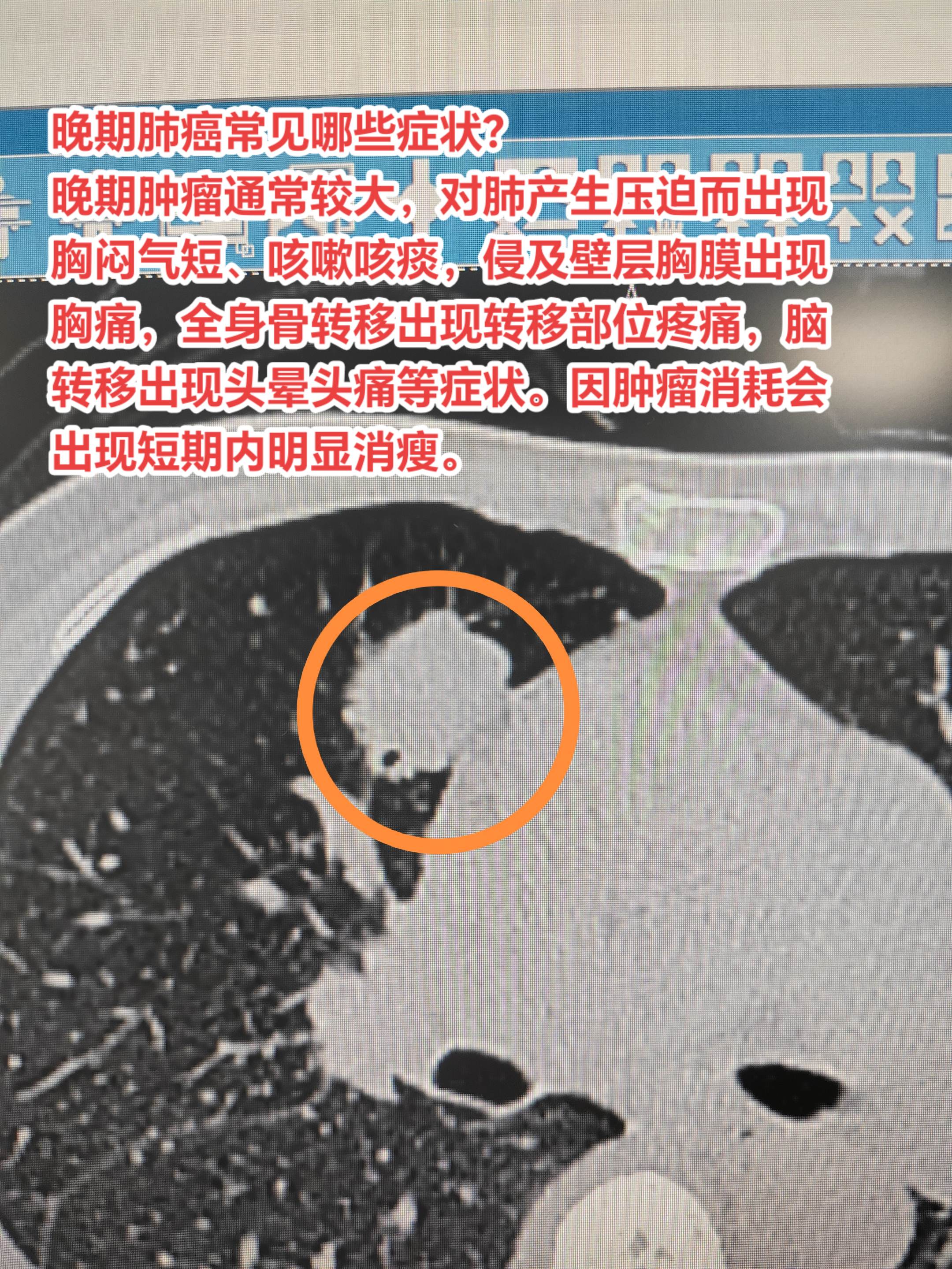 晚期肺癌常见哪些症状？晚期肿瘤通常较大，对肺产生压迫而出现胸闷气短、咳...