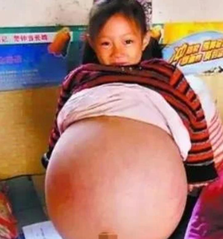 山西一个4岁小女孩，肚子鼓得像足月孕妇。多家医院诊断后，医生断言她活不过三个月。