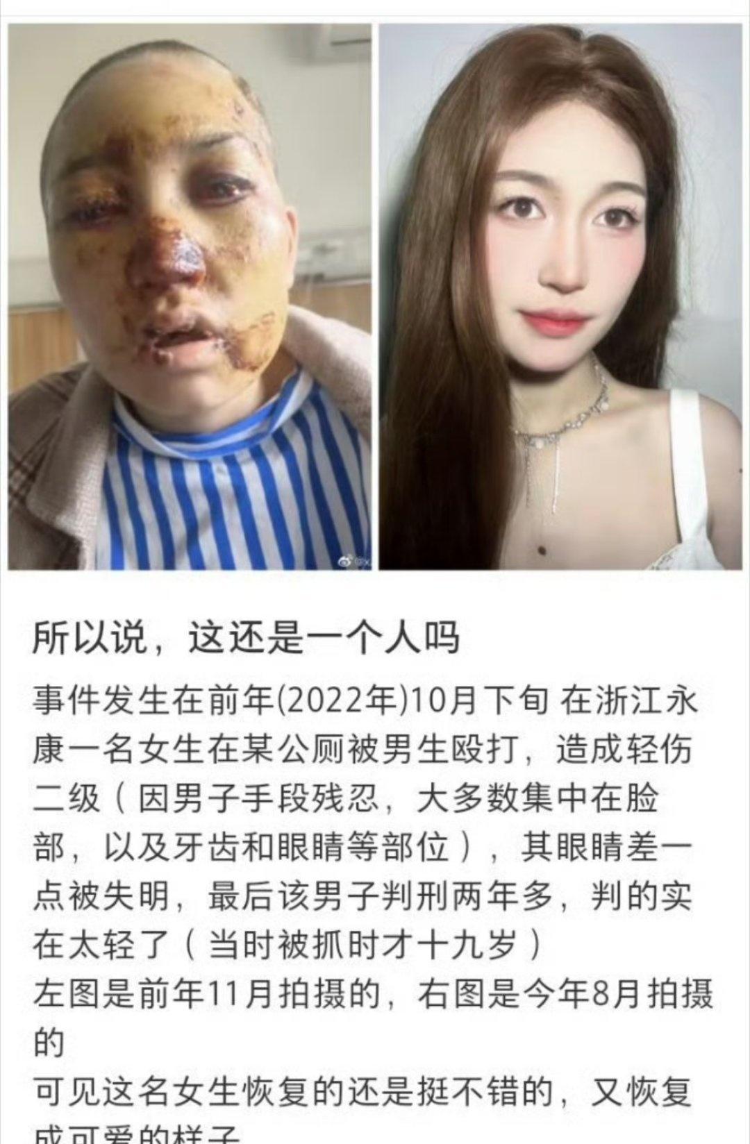 浙江公厕被打女孩确诊白血病天哪，19岁的年纪遇到天塌了的事情，光听到都觉得可怕