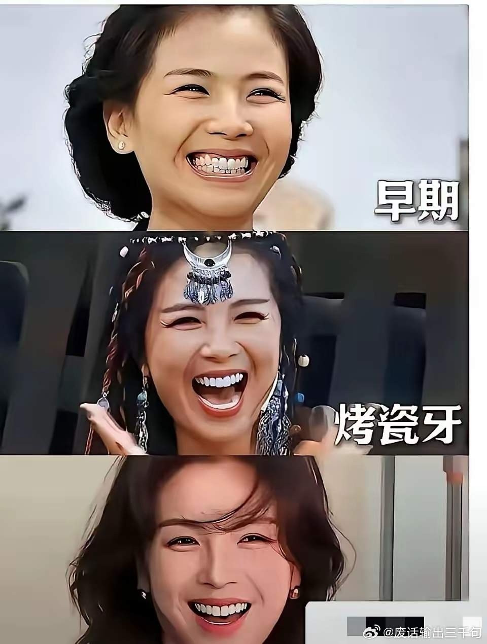 换了烤瓷牙，确实看起来漂亮多了