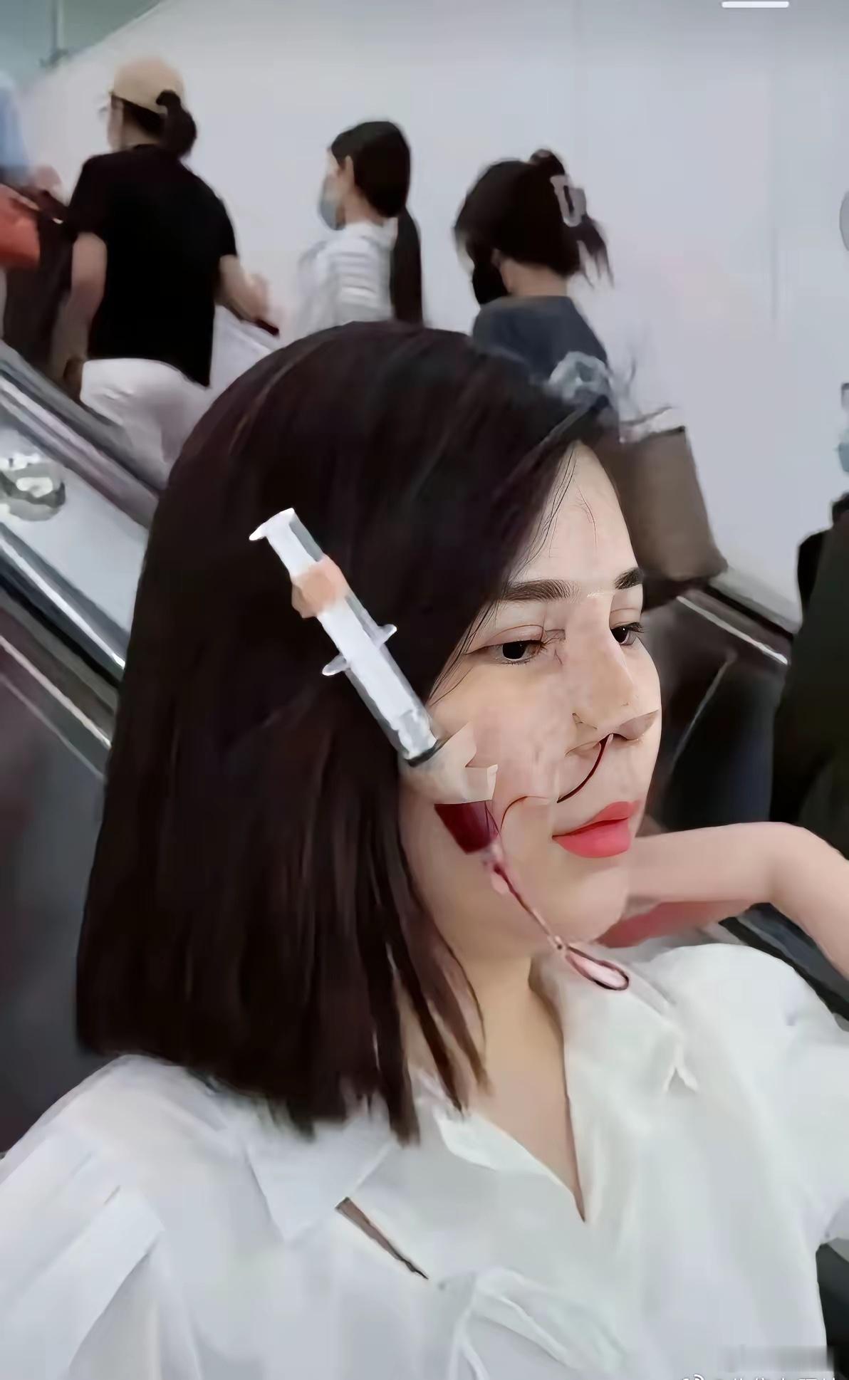 地铁偶遇一女生，着实吓了我一跳看得出来是刚做完整形项目，为了变美，着实下了不小