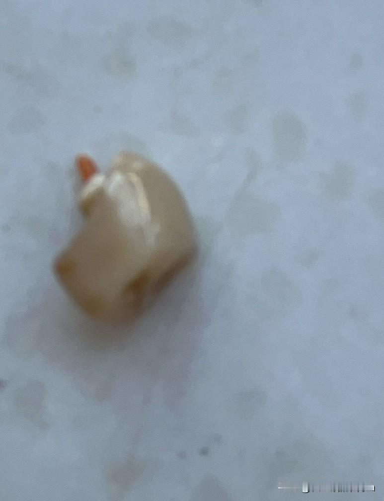 我是选择活动义齿还是种植牙？突然发现，我8年前镶的一个牙冠有些活动，今天去医