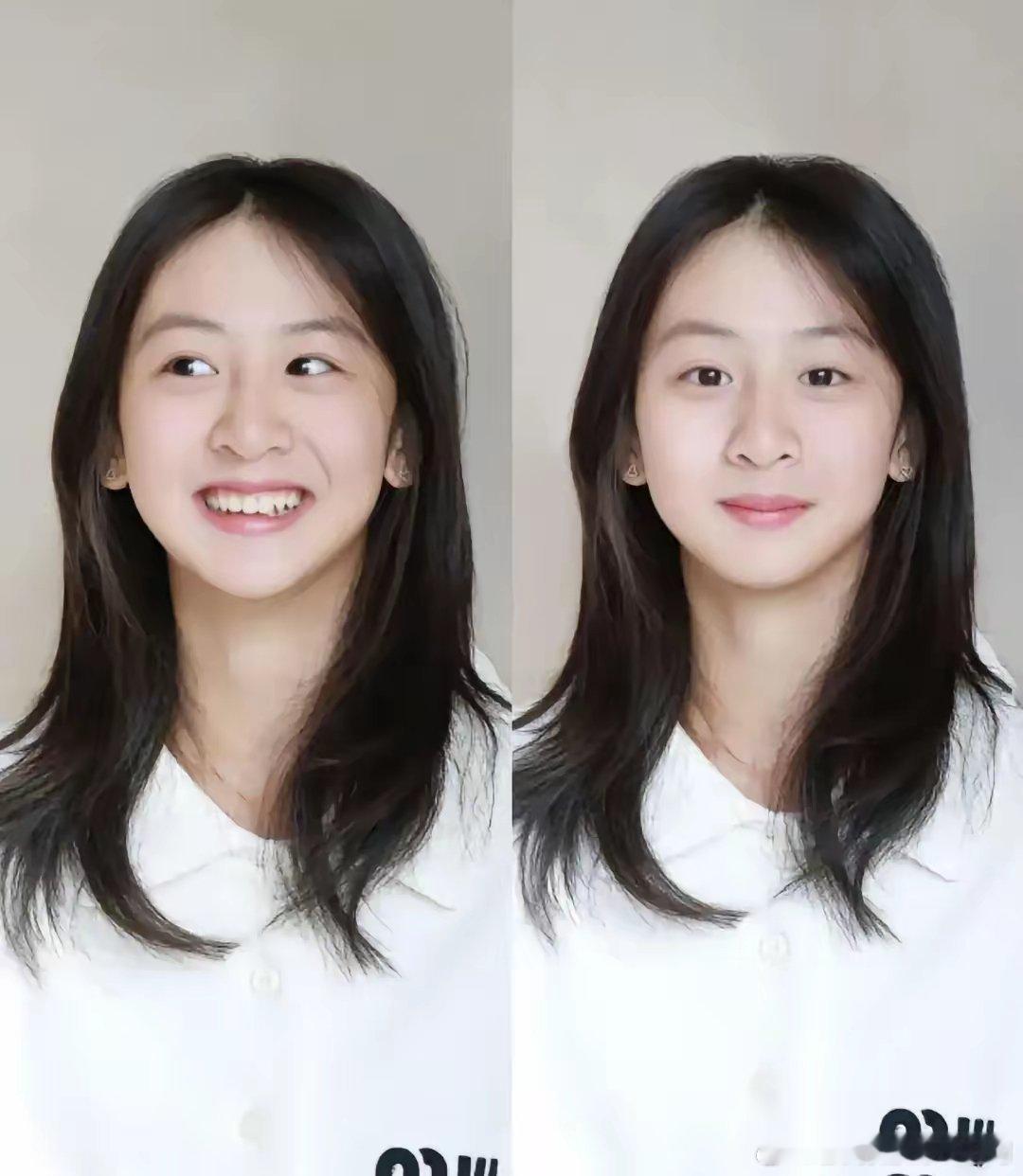 下巴后缩矫正，14岁已是末班车，再拖就晚了！森碟的生日照刚曝光，网友就炸开了锅，