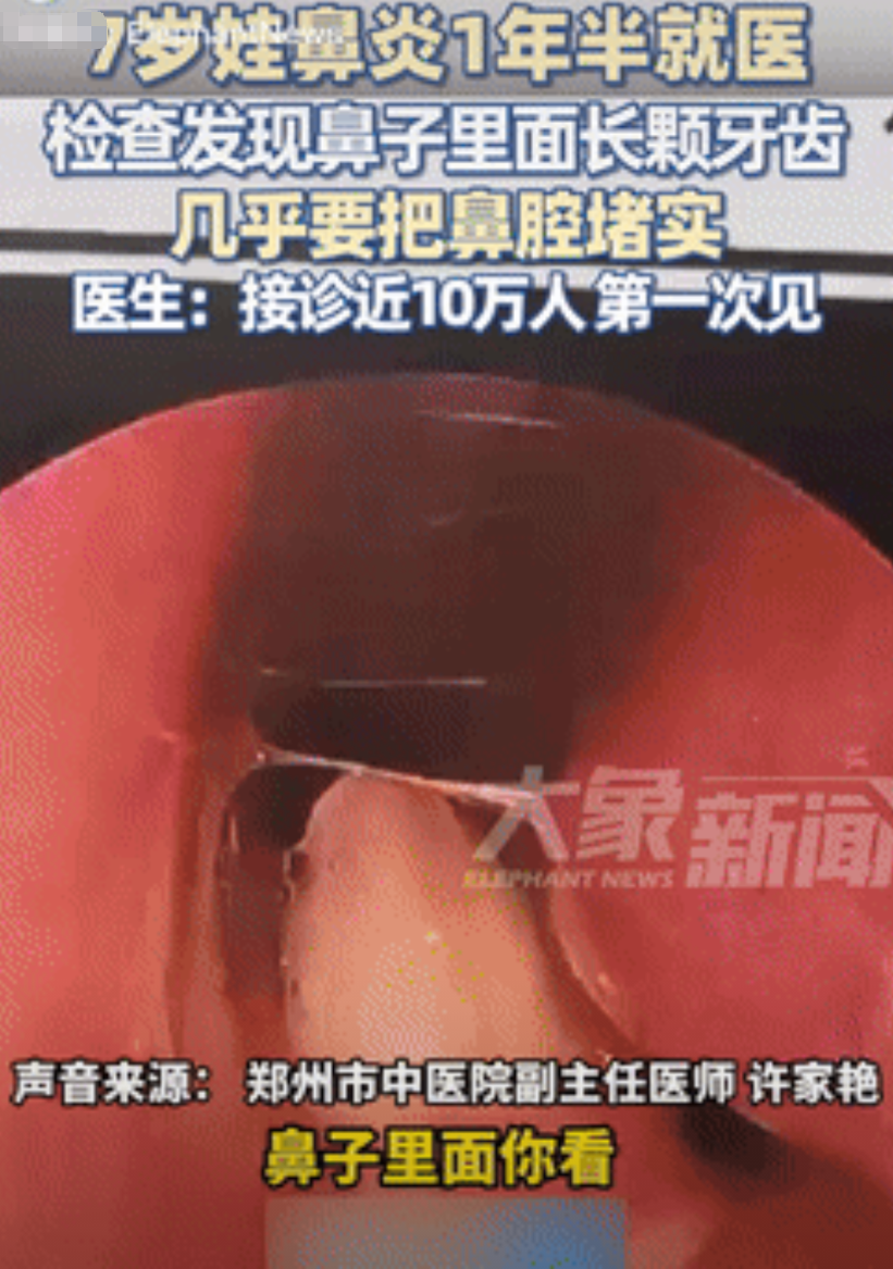 活久见！河南郑州，一7岁男孩因患鼻炎1年半，难受得不行，家长就带着他去医院，不料