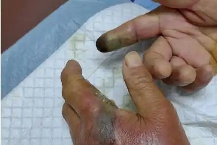 浙江一位大爷去河边钓鱼时，不慎被一条毒蛇咬伤，他想要把那条毒蛇抓起来到医院里给医