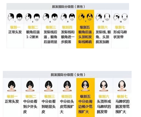 脱发很多种, 你属于哪一等级?