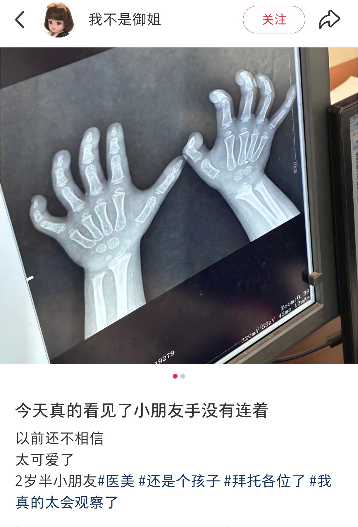 小朋友的手真的没有连着啊！
