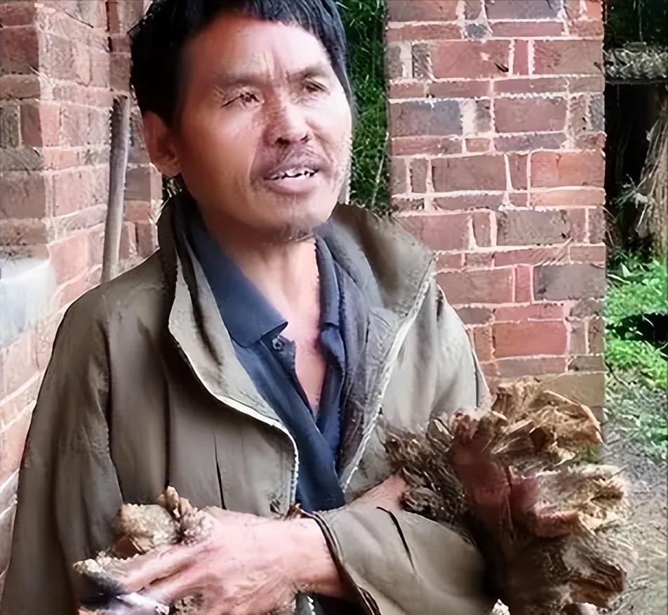 “我快要疼死了！”1992年，湖南小伙半夜惊醒，浑身火急火燎的疼，他开灯仔细一看