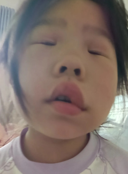一大早就被孩子吵醒，她说自己的嘴巴肿了。我赶紧起来查看，还真是嘴巴又肿又歪。