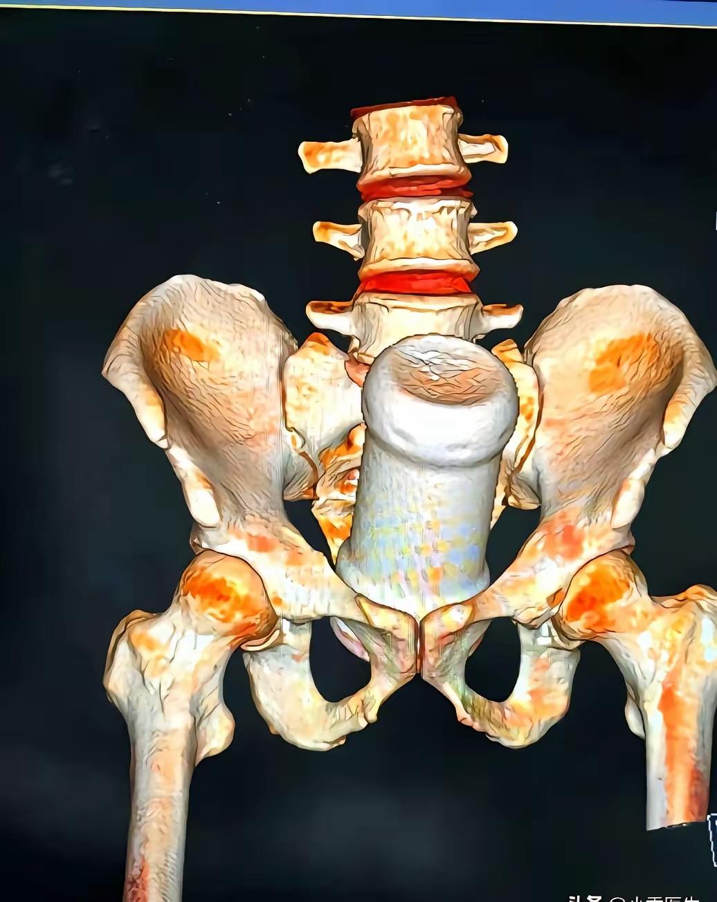 今天门诊进来一位29岁的姑娘，她弯着腰捂着肚子，疼得直哼哼，在诊室里折腾了整整一