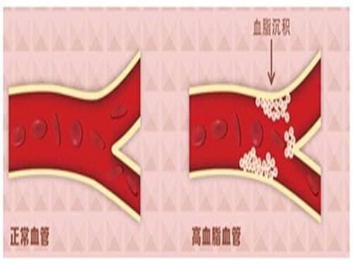 身体发出的这4个信号, 是在提示你血脂太高, 再不注意血管就堵了