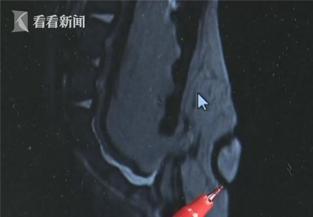 五月婴儿长出神秘“猪尾巴”险致瘫痪 竟是因母亲孕期缺少叶酸