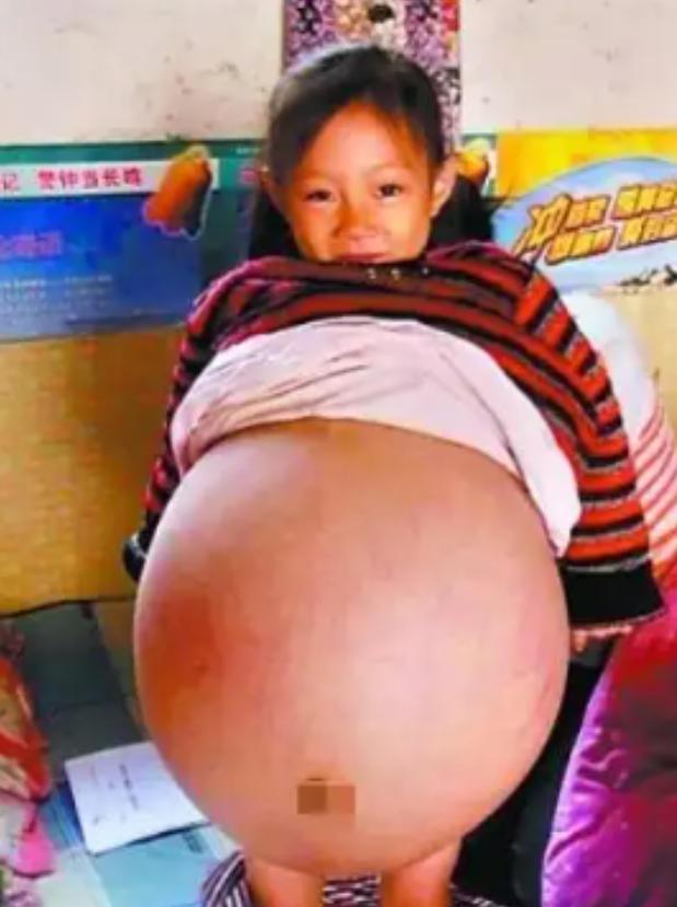 2010年，山西4岁女孩肚子涨大得像孕妇，医生预言活不过三个月，父母深感绝望，就