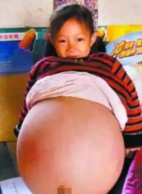 2010年，山西4岁女孩胡云星，肚子超大鼓胀得像孕妇。医生预言活不过三个月，就在