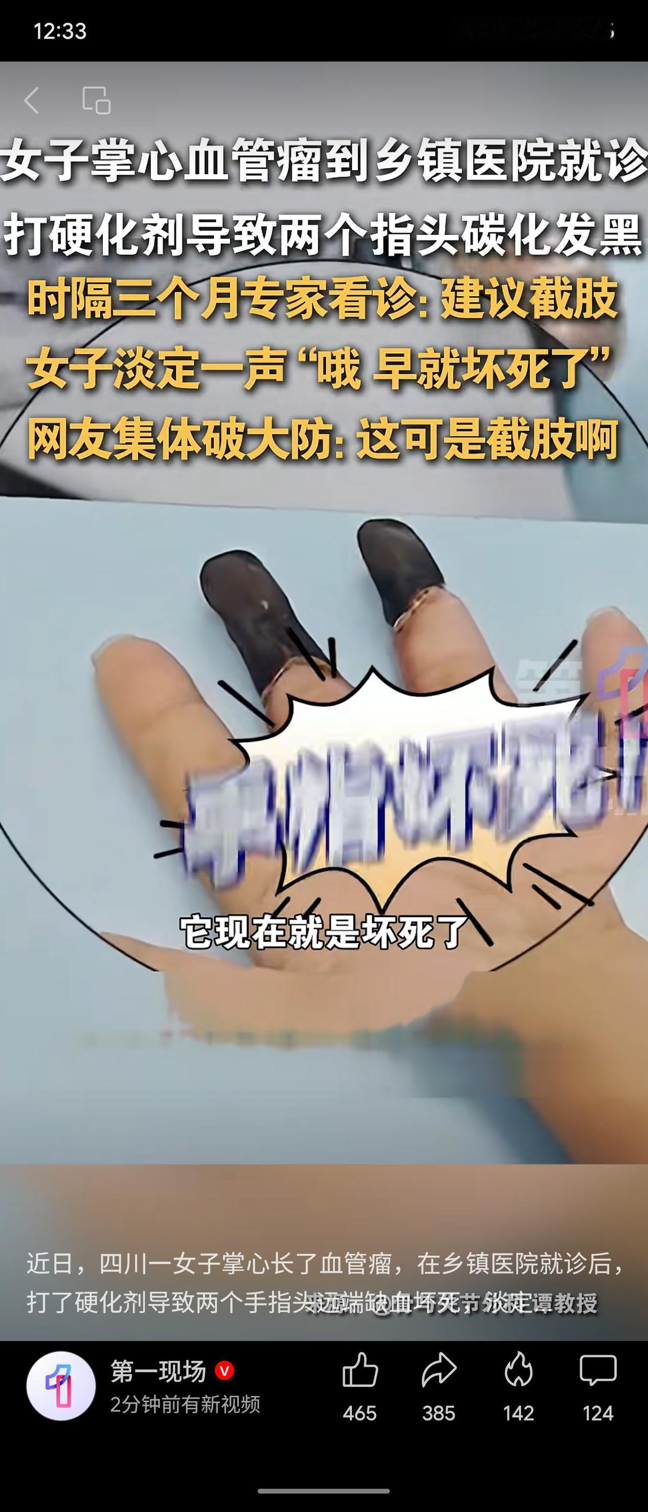 四川一女子掌心血管瘤，于乡镇医院注射硬化剂治疗，致两指远端缺血坏死。时隔三月，专
