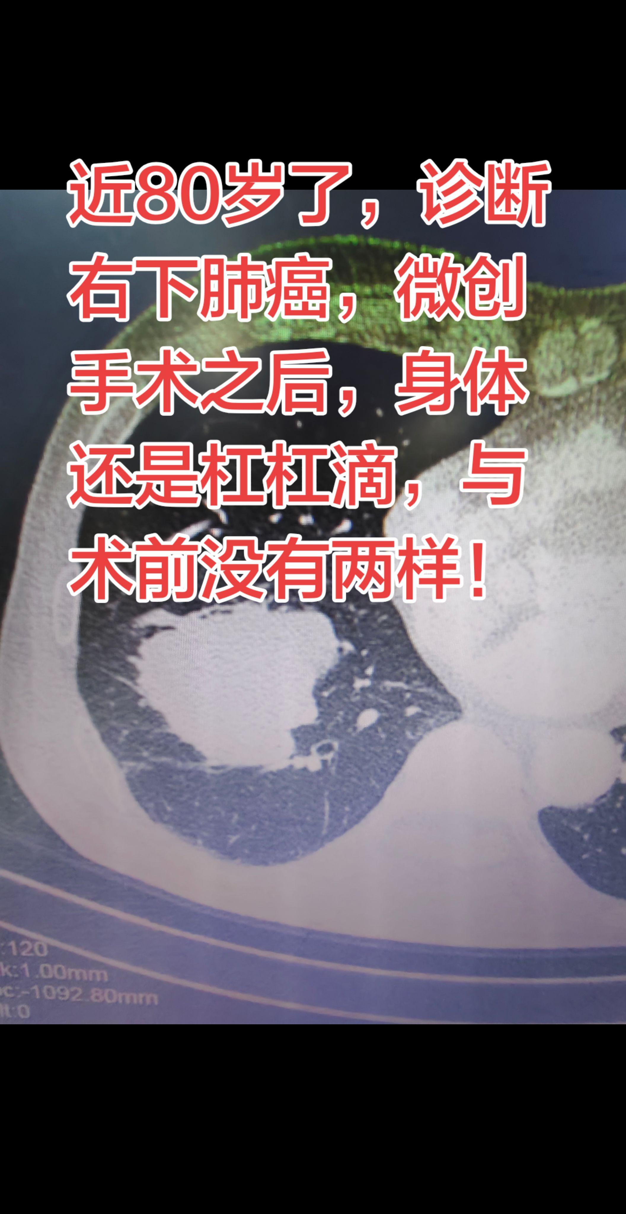 年纪大了，肺癌，也可以手术。近80岁了，诊断右下肺癌，微创手术之后，身...