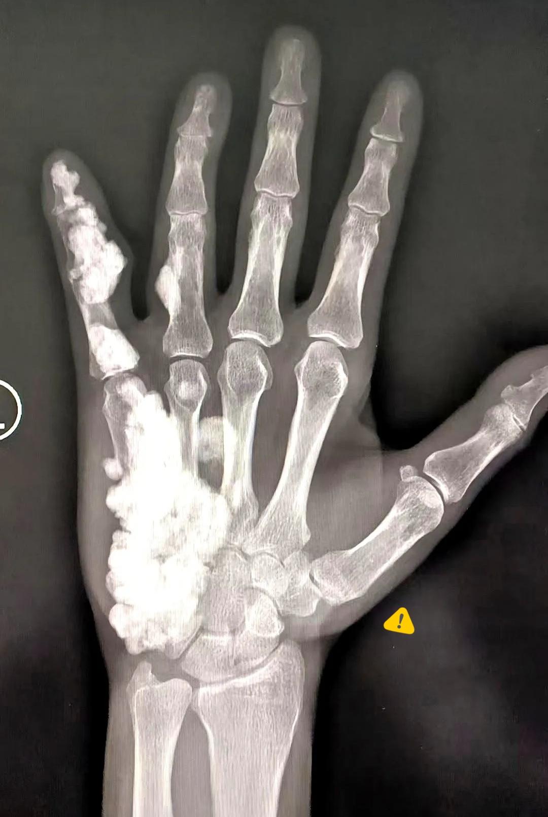 17岁，左手疼了整整10年。拍了个片子，我人都看傻了。这根本不像正常骨头，像