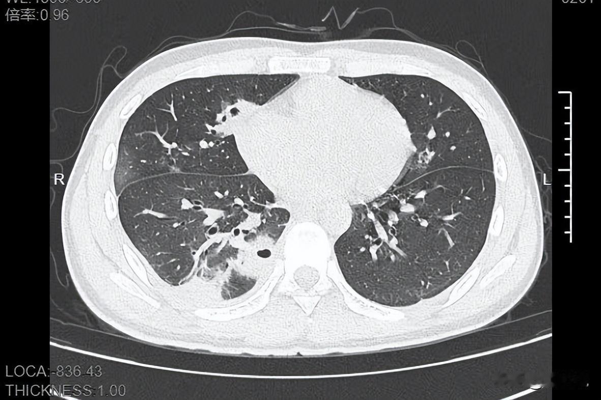 “我再也不手欠了！”浙江宁波，一名大二男生看到脸上长了几个痘痘，很影响自己的形象
