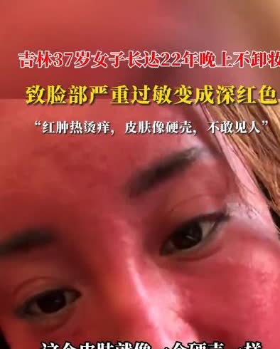 悲剧还是发生了！吉林37岁女子因为太懒，22年来从不卸妆，如今脸部严重过