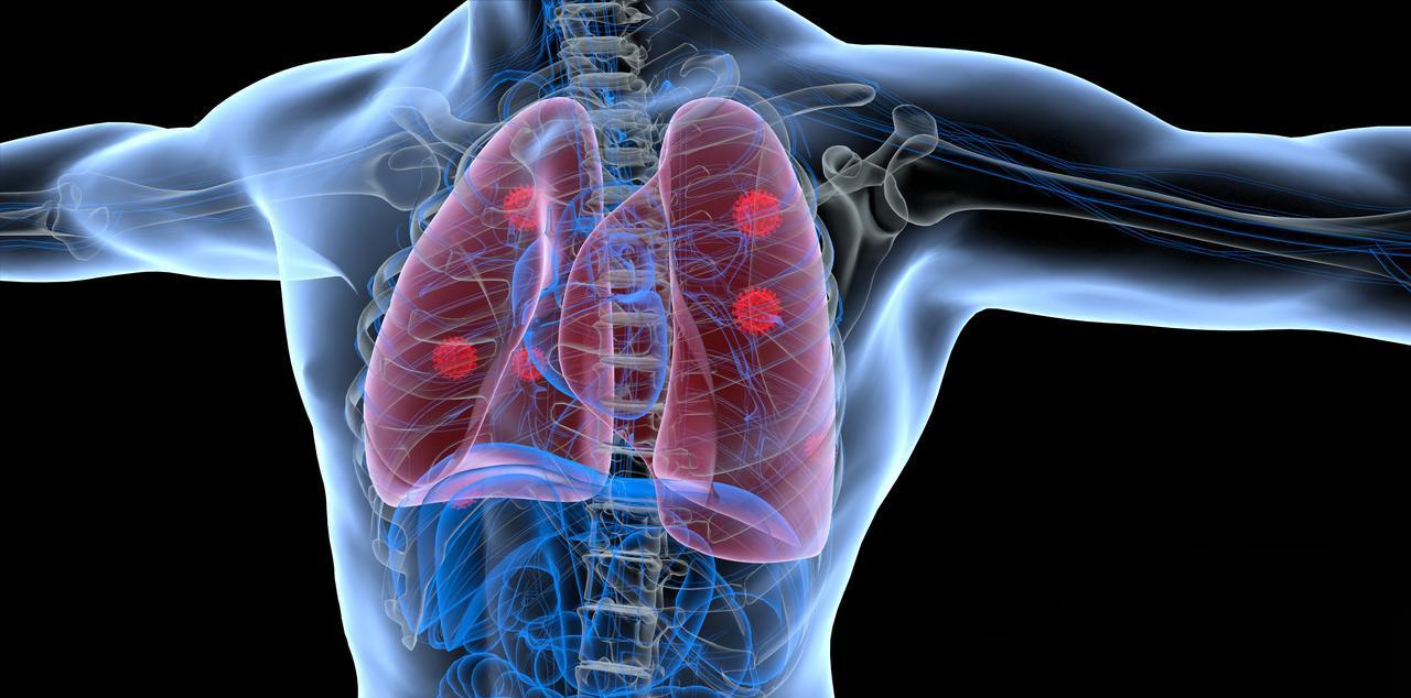 什么人更容易患肺癌？五种人尤其要当心，定期体检早期发现很重要肺癌的发病是遗传与