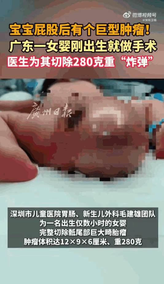 产检发现胎儿屁股长“拳头大肿瘤”，父母赌命生下！医生一刀切下280克肉瘤，现场医