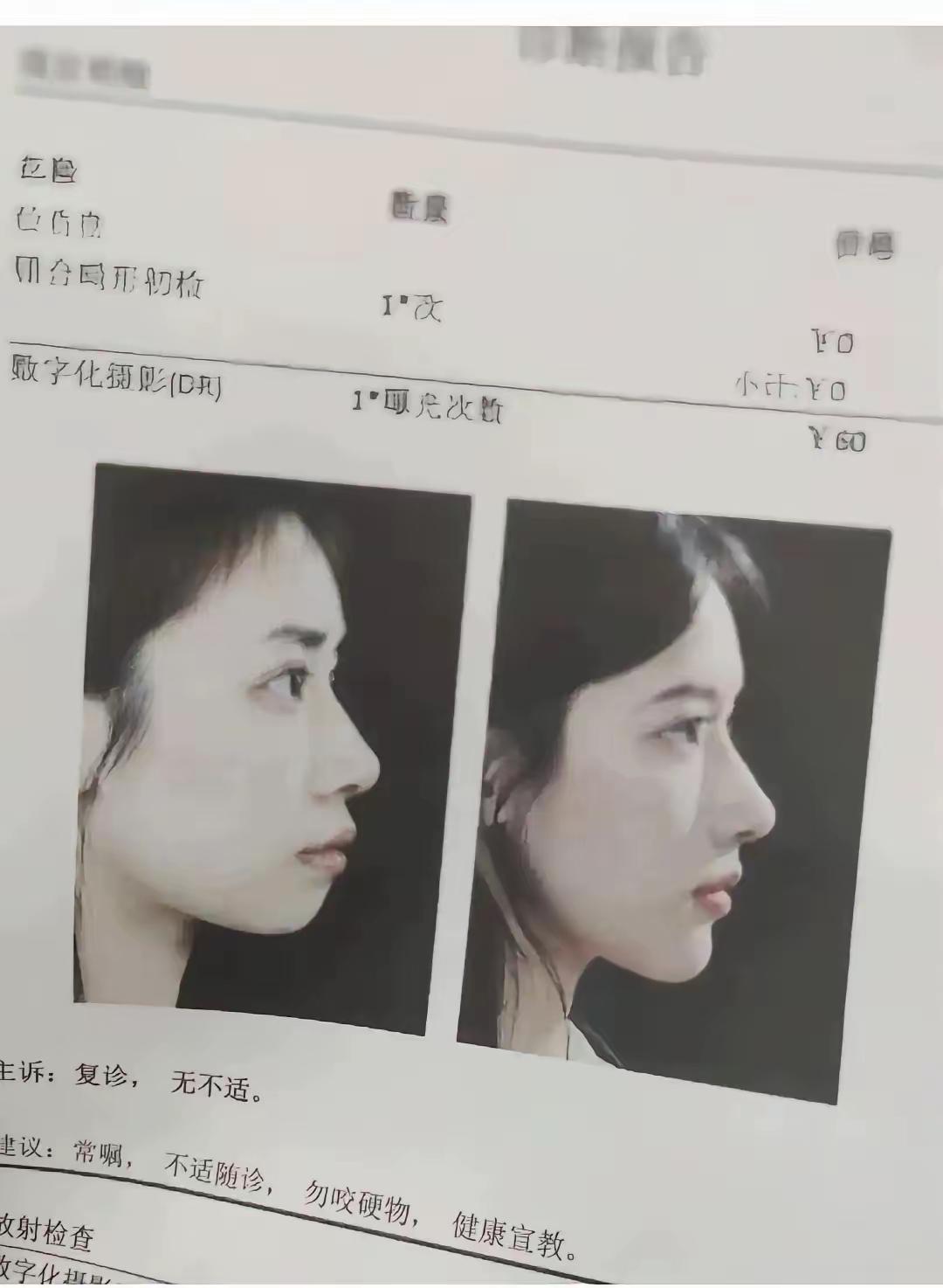 这脸到底怎么变的，竟然是同一个人？有人说换了牙？这可能吗？还是换了骨头了？削