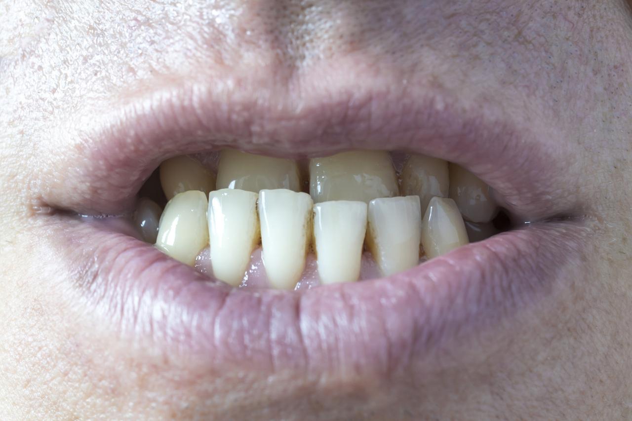 人不会无缘无故牙龈萎缩！医生：牙龈萎缩的人，多半有这5习惯上周门诊，52岁的李