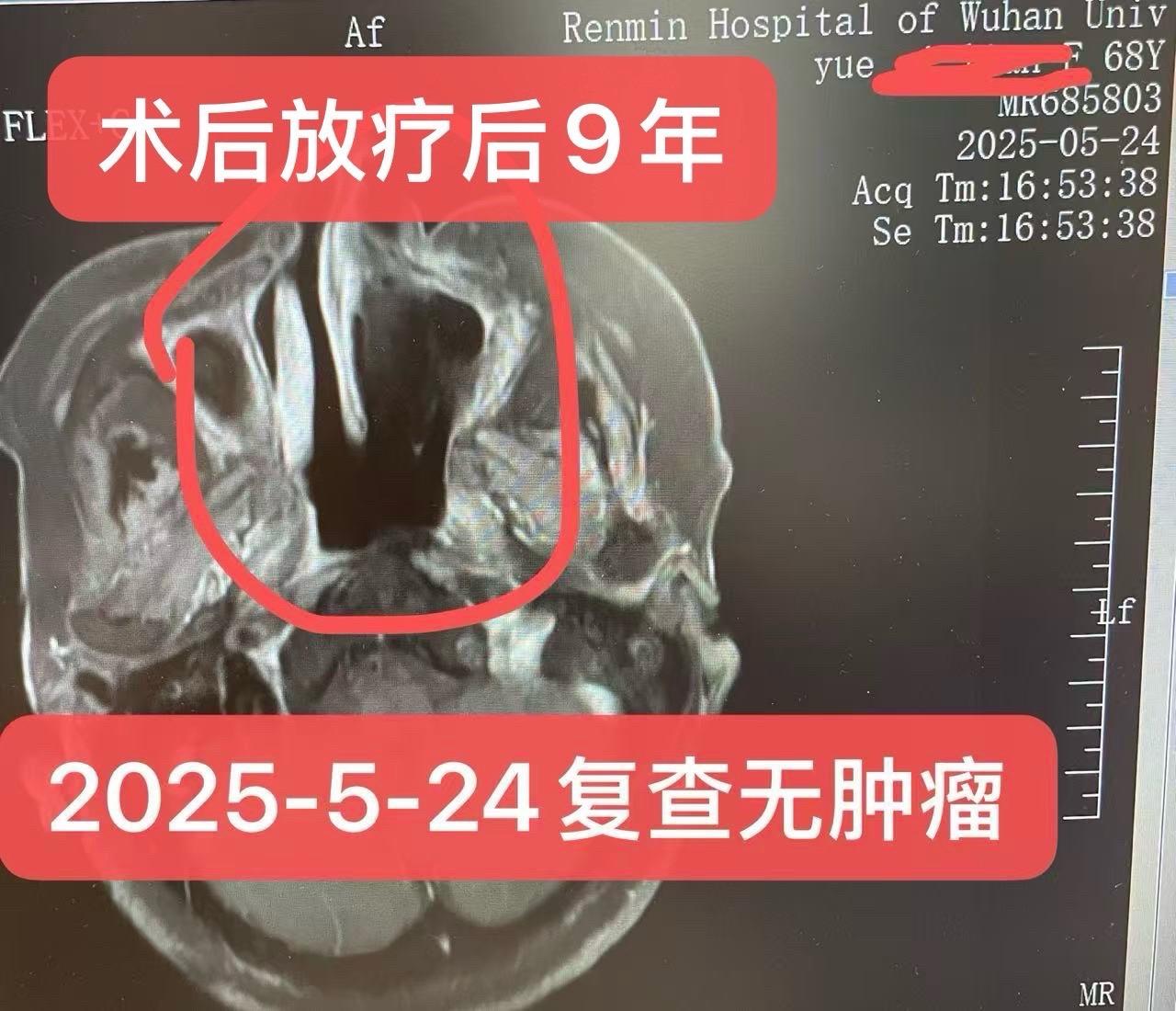 上颌窦腺癌术后残留行放疗已9年，治愈！上颌窦腺癌，女，60岁，术后难以...