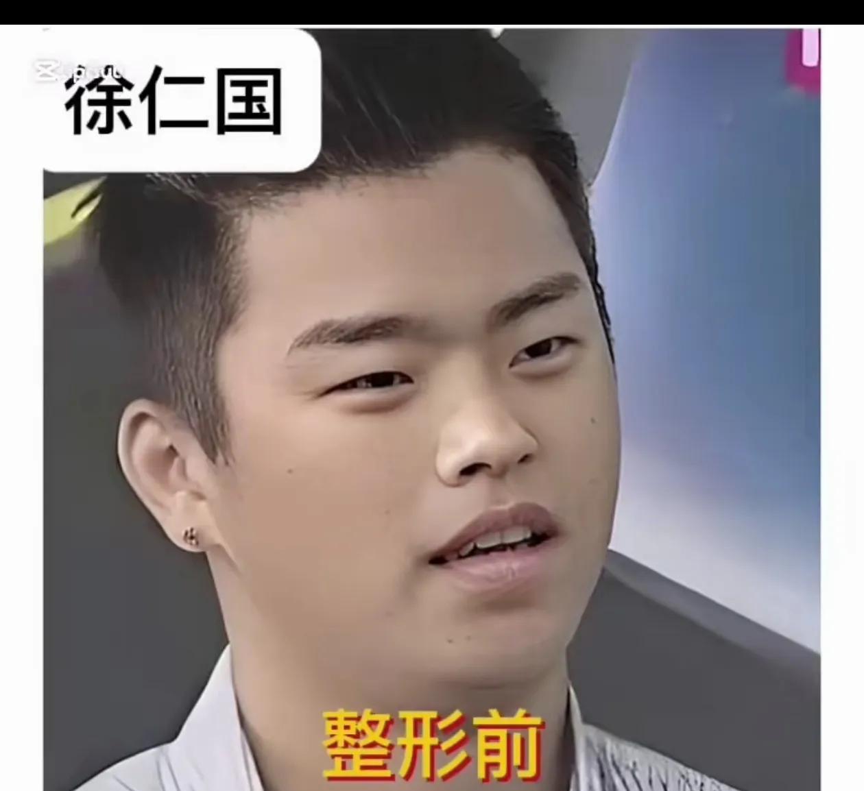 来看看你们滴欧巴整容前后对比吧！不得不说颜值的上限看脸型鼻子呀！眼睛不太丑就可