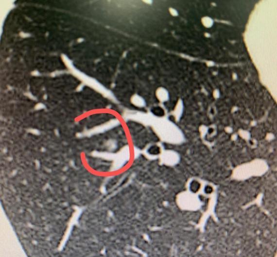 这位49岁的女患者，因为父母都曾患过癌症，所以一直很重视身体，每年坚持体检。就在