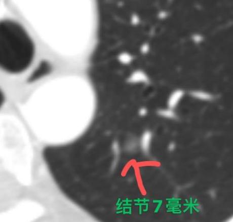 “从查出肺癌到离开，连一年都不到。”诊室里，这位32岁的患者说起家里的情况，眼圈