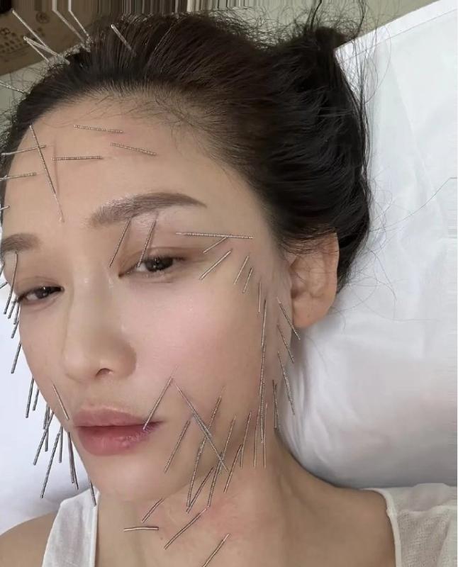 陈乔恩对自己还是太狠了为了保养，全身上下扎几百针，做针雕项目，之前被爆出为了保
