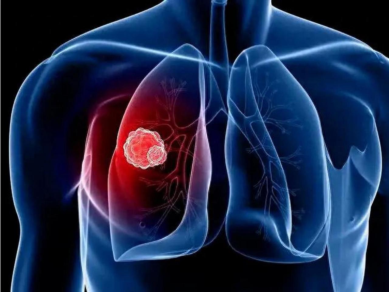 肺癌的第一信号，不看胸口疼不疼，医生：身体7个迹象要留意很多人都知道胸口痛可