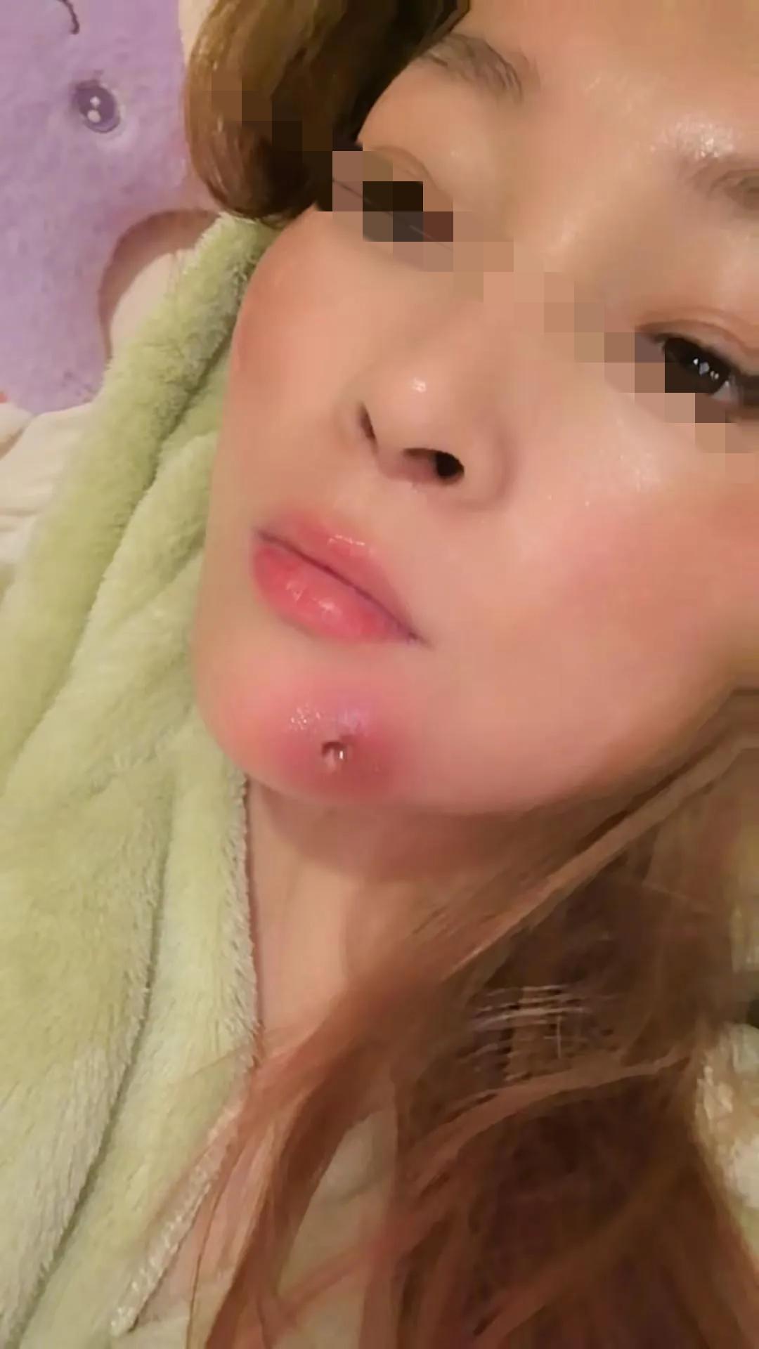 火疖子，好想给她挤了呀！这玩儿没别的，就让人给挤挤就好的快些。没招儿，忍着疼