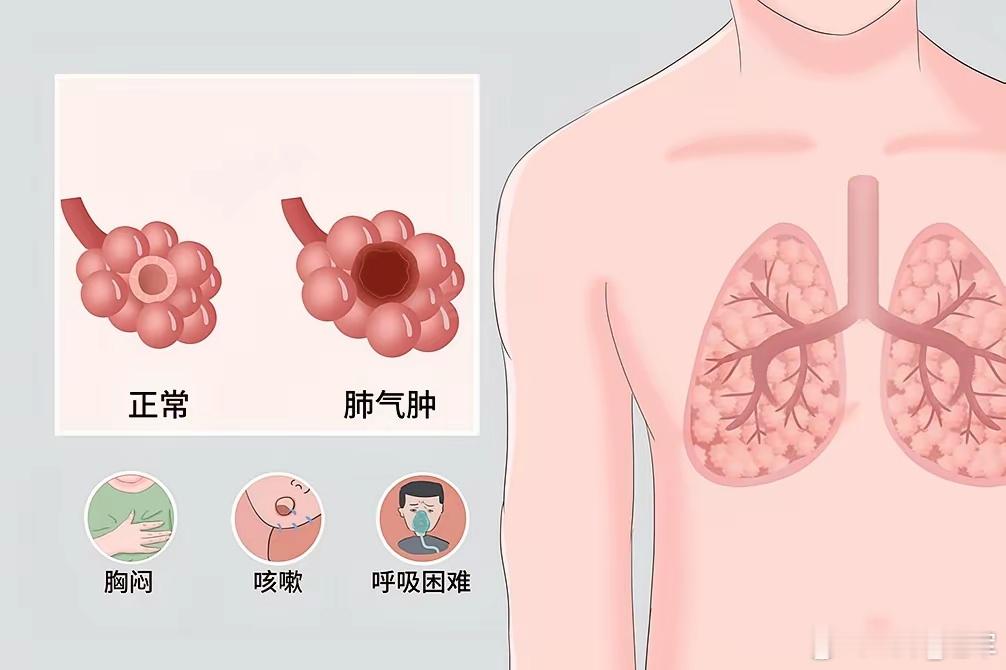 三子人参汤治肺气肿​【功能主治】此方扶正祛邪，降气化痰，适用于痰涎壅盛所致的肺