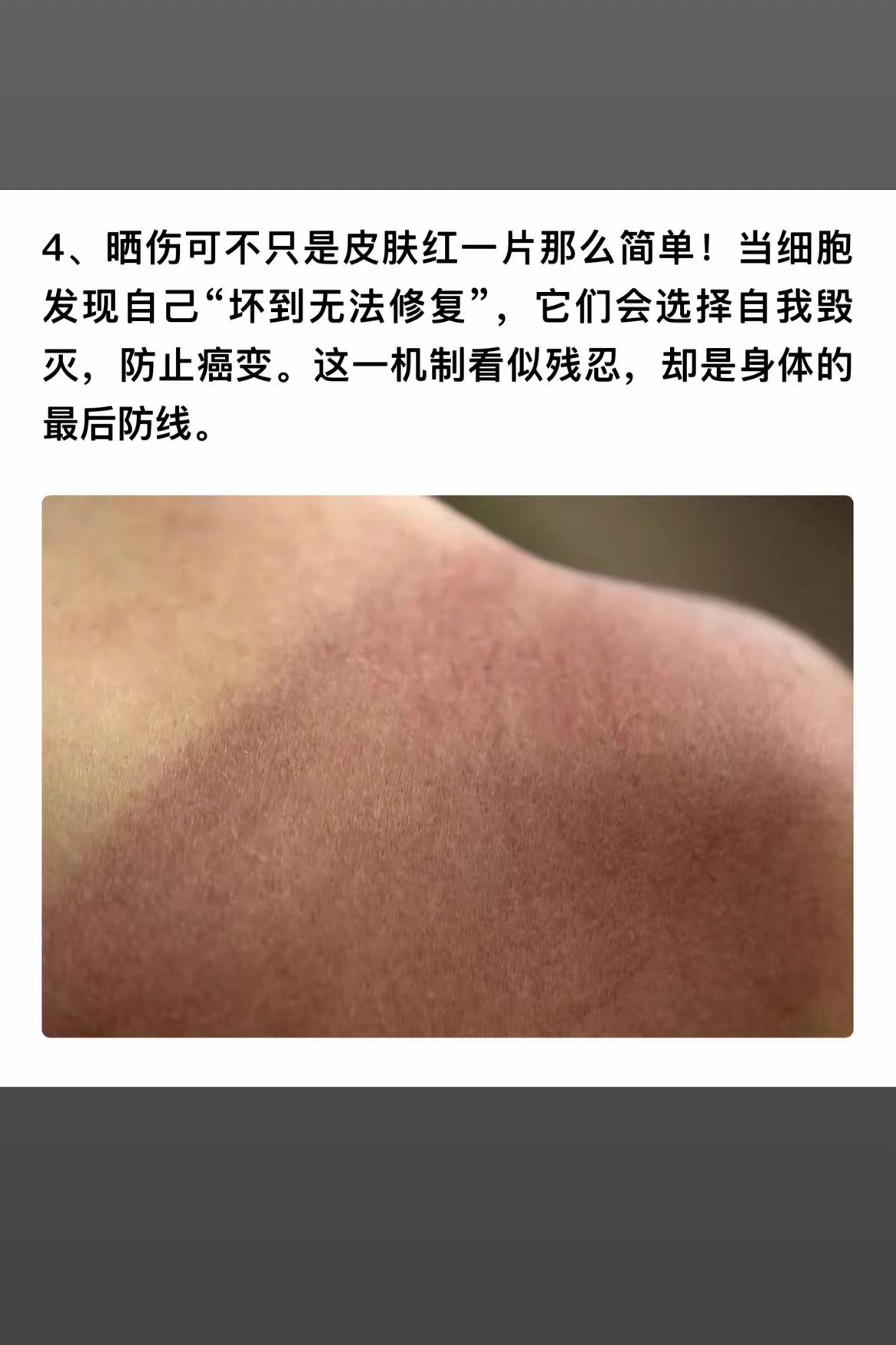 晒伤后皮肤自我毁灭机制揭秘