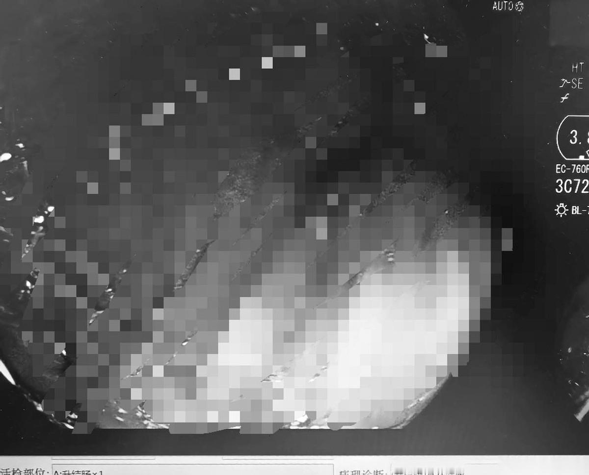 43岁的杨先生，走进体检中心，选了肠镜项目。人躺在检查床上，没什么特别感觉，旁