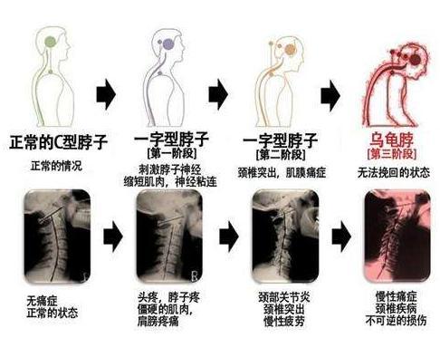 颈椎病, 富贵包, 都是什么造成的? 教你怎么锻炼!