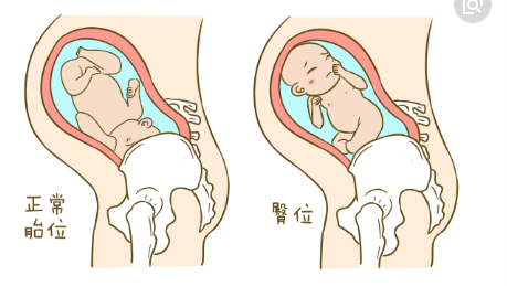 准妈妈们怕胎位不正会难产! “鬼门关”前用这3种办法纠正胎位异常