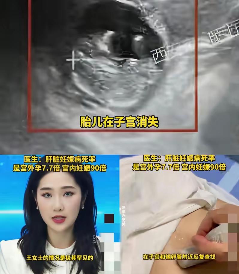 这怀孕简直离谱到颠覆认知！西安40岁大姐停经50天查出怀孕，可子宫、输卵管里压根